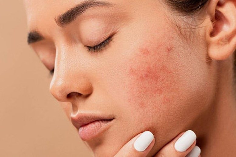 Norit - Hoy es el día mundial de la Dermatitis atópica, un trastorno que  provoca el enrojecimiento de la piel y picazón🔥. Aunque por supuesto lo  que te recomendamos es que vayas