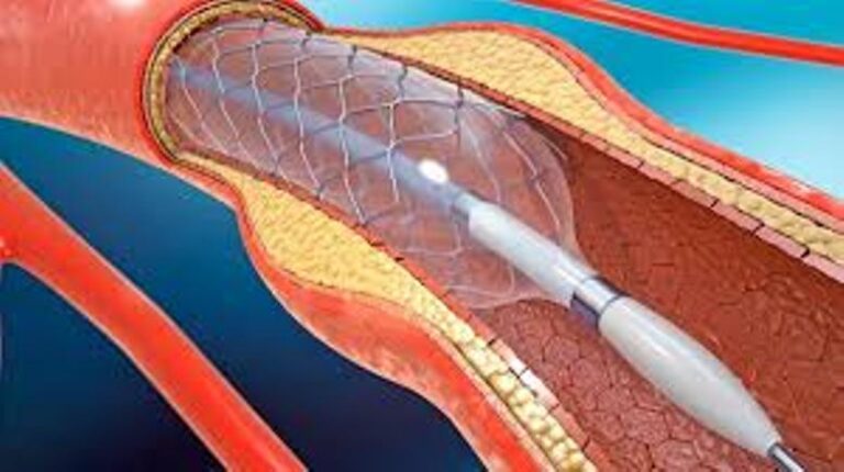 Duro comunicado de los Cardiólogos Intervencionistas: “No podrán colocarse más stents”