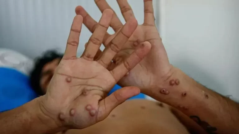 Viruela del mono: riesgo de una nueva pandemia?