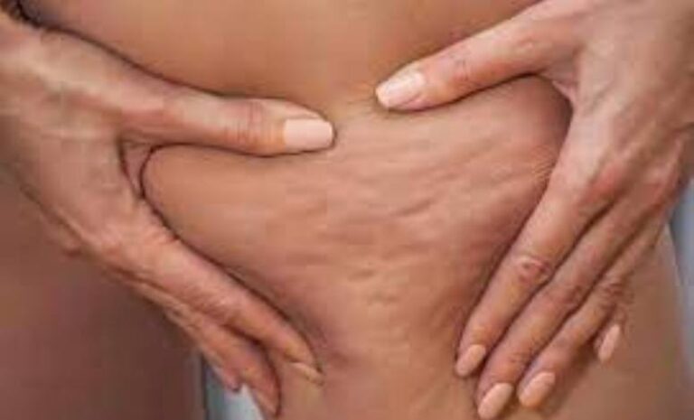 La Anmat prohibió un gel para tratar la celulitis