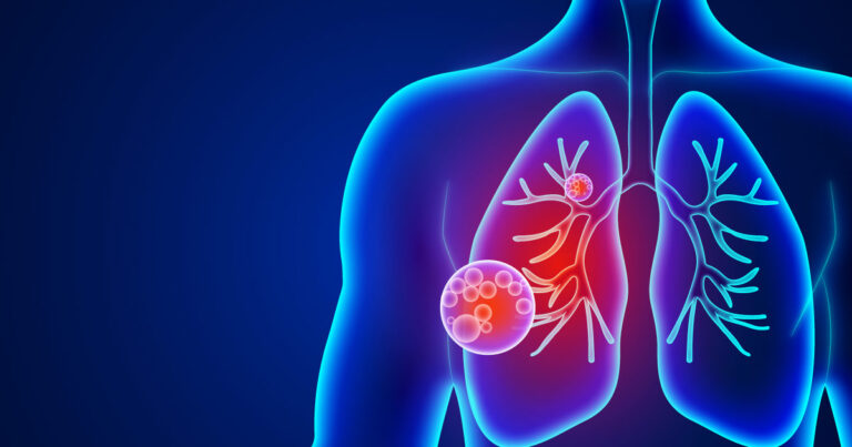 La neumonía mata a 800.000 niños cada año: una enfermedad prevenible que sigue siendo la principal causa de muerte infantil