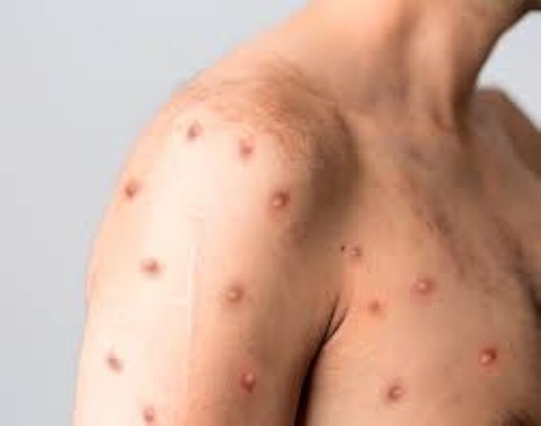 Confirman el primer caso de Viruela Símica mpox Clado II en el país