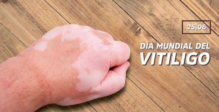 Día Mundial del Vitíligo: una fecha para visibilizar y combatir la discriminación