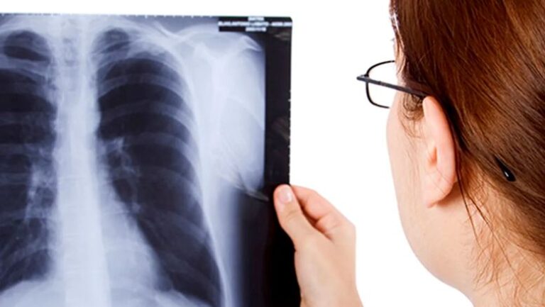 Tuberculosis en Argentina: los casos crecieron más de 71,6% desde 2020 y alertan por posibles diagnósticos no registrados